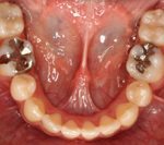 汐留シティセンター歯科 矯正治療 矯正を終えた状態_5