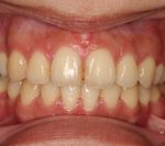 汐留シティセンター歯科 矯正治療 矯正を終えた状態_3