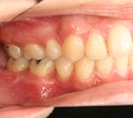 汐留シティセンター歯科 矯正治療 矯正を終えた状態_2