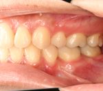 汐留シティセンター歯科 矯正治療 矯正を終えた状態_4