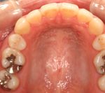 汐留シティセンター歯科 矯正治療 矯正を終えた状態_1