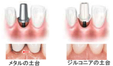 上部構造(かぶせもの)の作成・装着