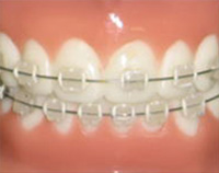 汐留シティセンター歯科 矯正治療 セラミック
