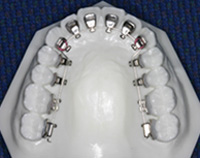 汐留シティセンター歯科 矯正歯科 内側矯正治療