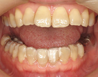 汐留いシティセンター歯科 矯正歯科 クリアリテーナー矯正