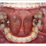汐留シティセンター歯科 矯正治療 矯正中_5