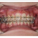 汐留シティセンター歯科 矯正治療 矯正中_3