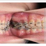 汐留シティセンター歯科 矯正治療 矯正中_2