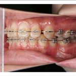 汐留シティセンター歯科 矯正治療 矯正中_4