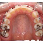 汐留シティセンター歯科 矯正治療 矯正中_1