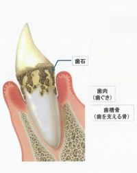 汐留シティセンター歯科 歯周病治療 歯周病の歯茎の状態
